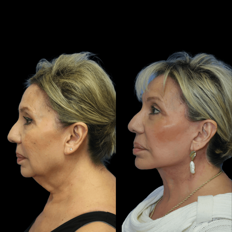 deep plane facelift before and after