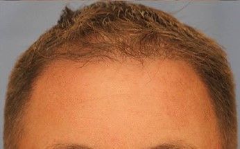 Hair Loss Restoration Before & After