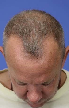 Hair Loss Restoration Before & After